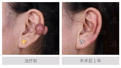 昆明医院哪家治疗疤痕最好