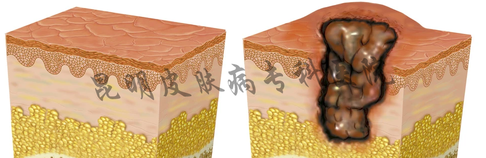 昆明谁家疤痕病医院好