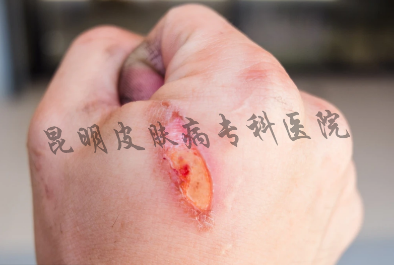 昆明比较正规疤痕病医院
